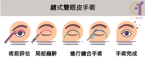 縫雙眼皮手術流程圖