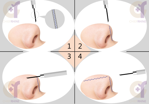 線雕隆鼻流程圖
