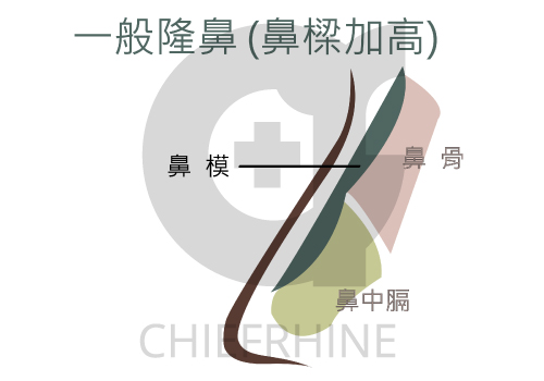 一段式隆鼻