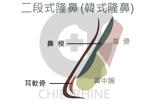 二段式隆鼻
