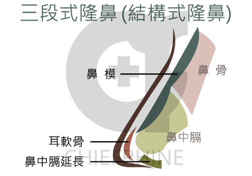 三段式隆鼻
