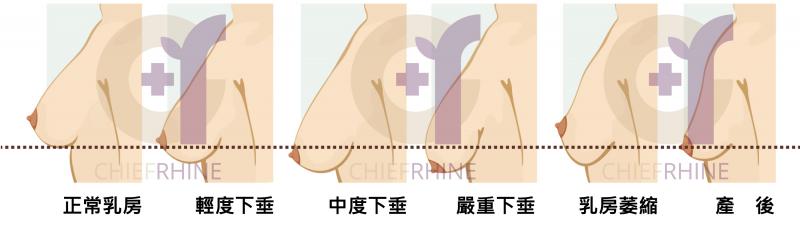 乳房下垂程度示意圖