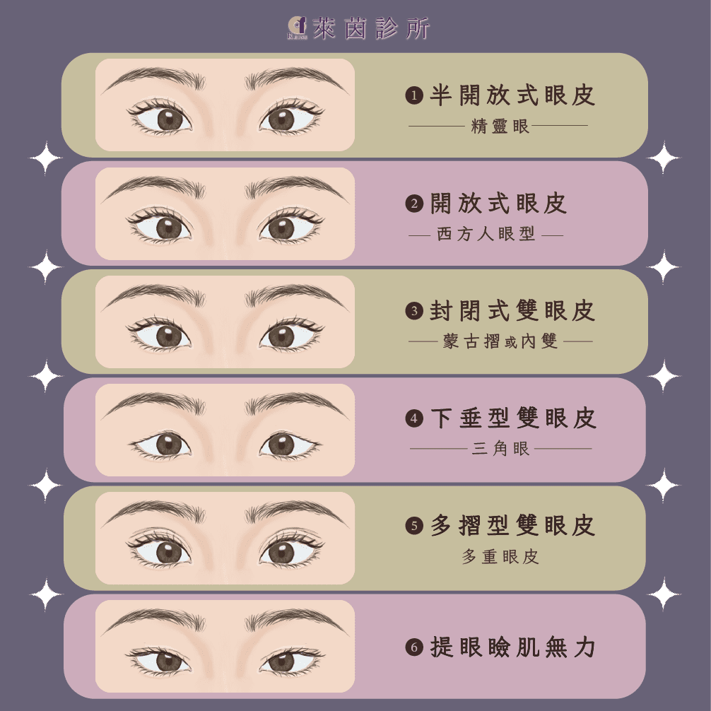 雙眼皮種類比較圖
