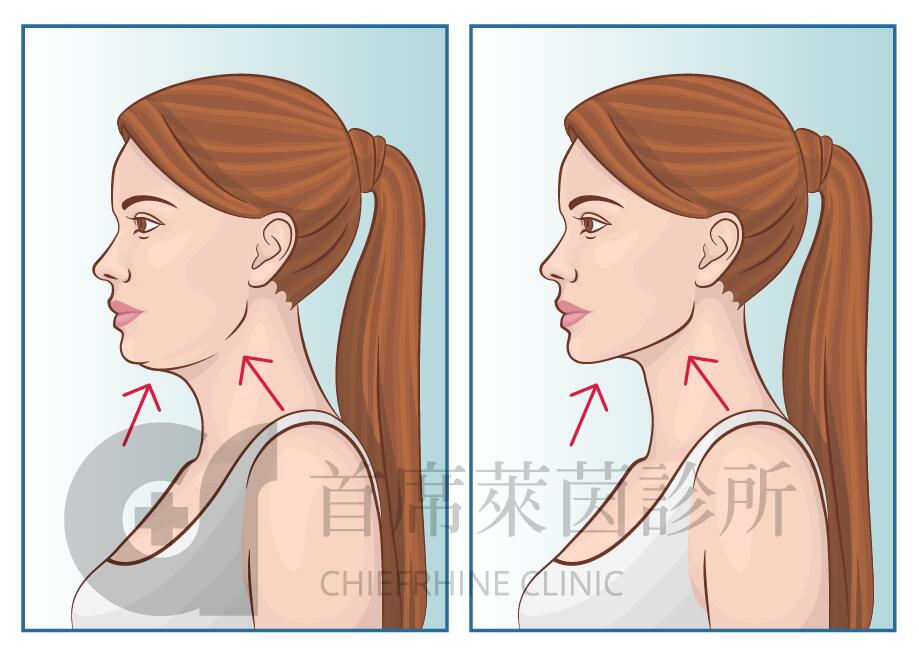 fat-removal on face