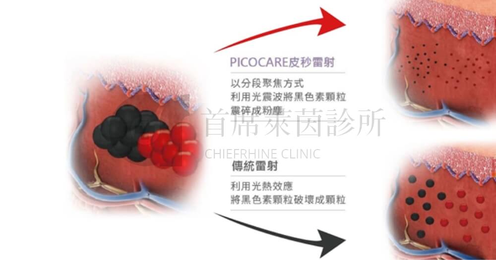 擊碎黑色素，皮秒雷射與傳統雷射比較