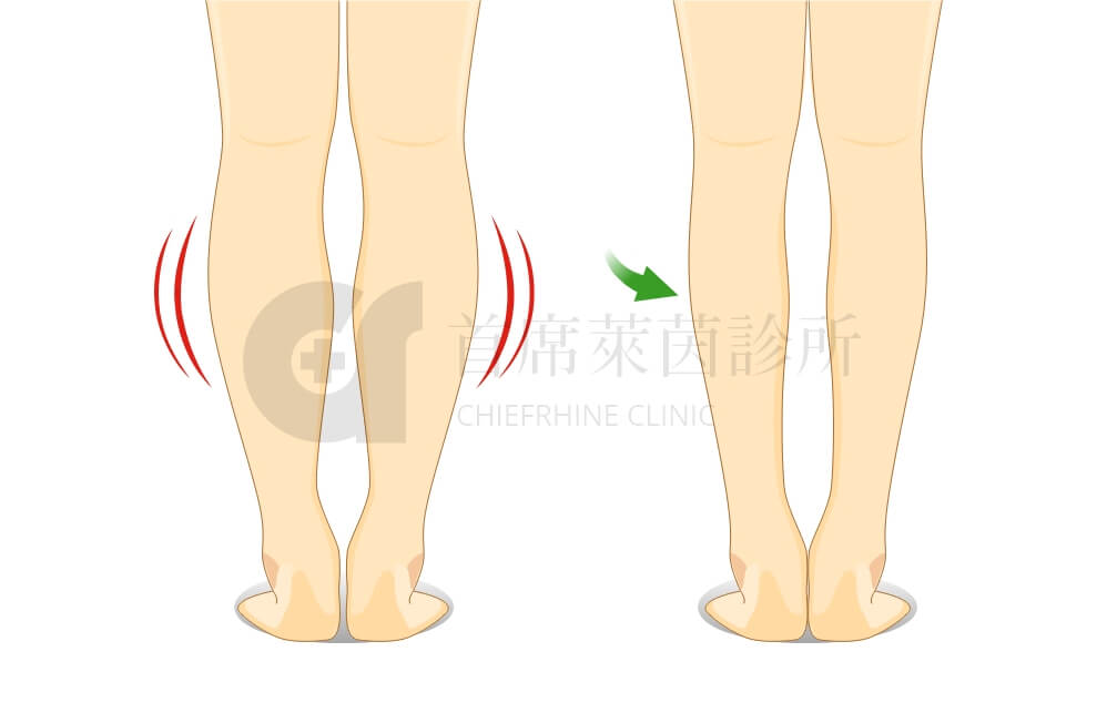 Skinny-legs